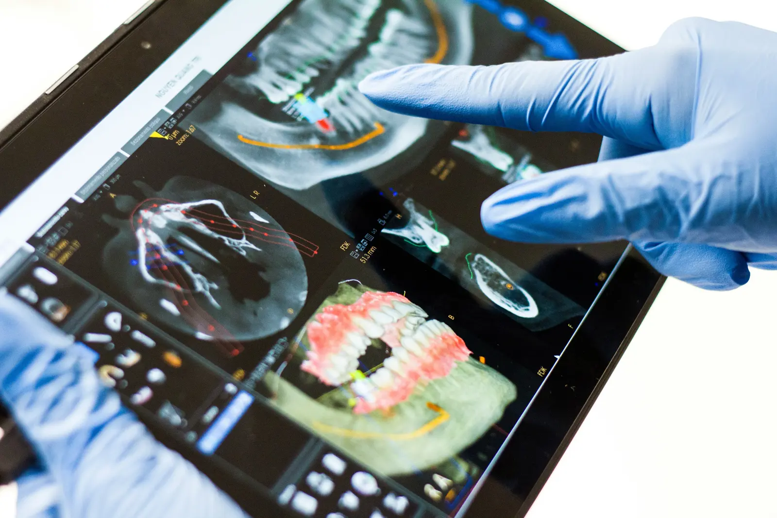 CBCT implant planning reviewed on a tablet, shown while covering Implant Crown in Winnipeg