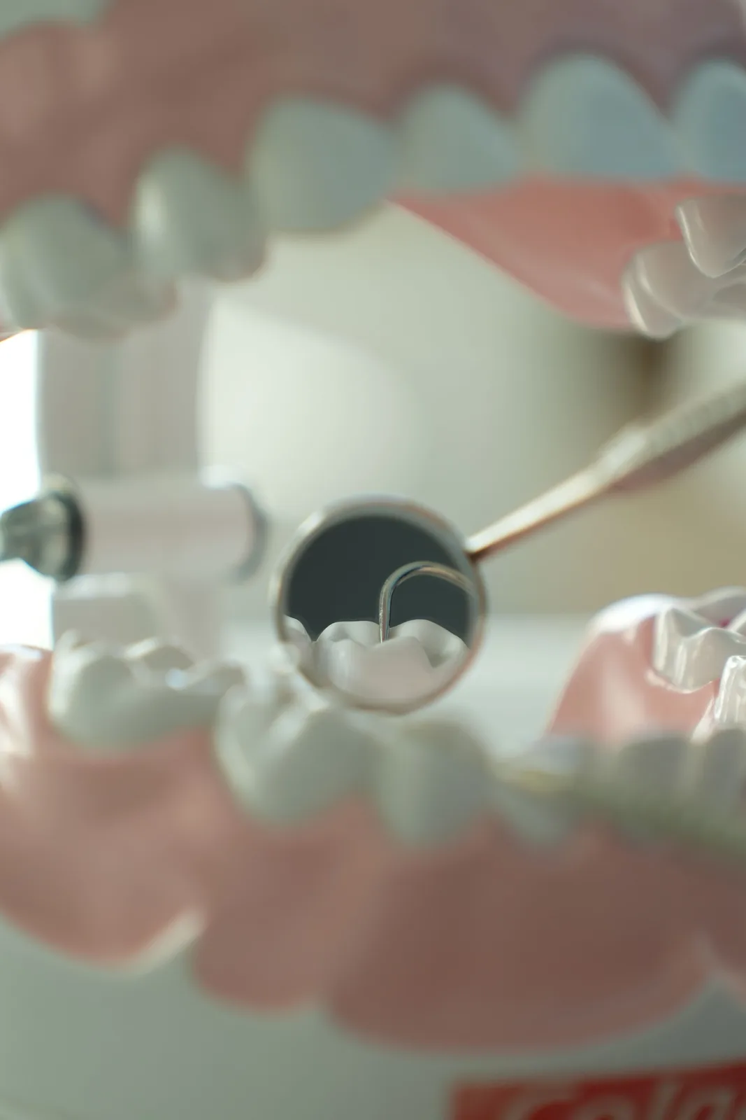 Dental mirror view inside the mouth, referred to in the Bone Grafting section for Winnipeg