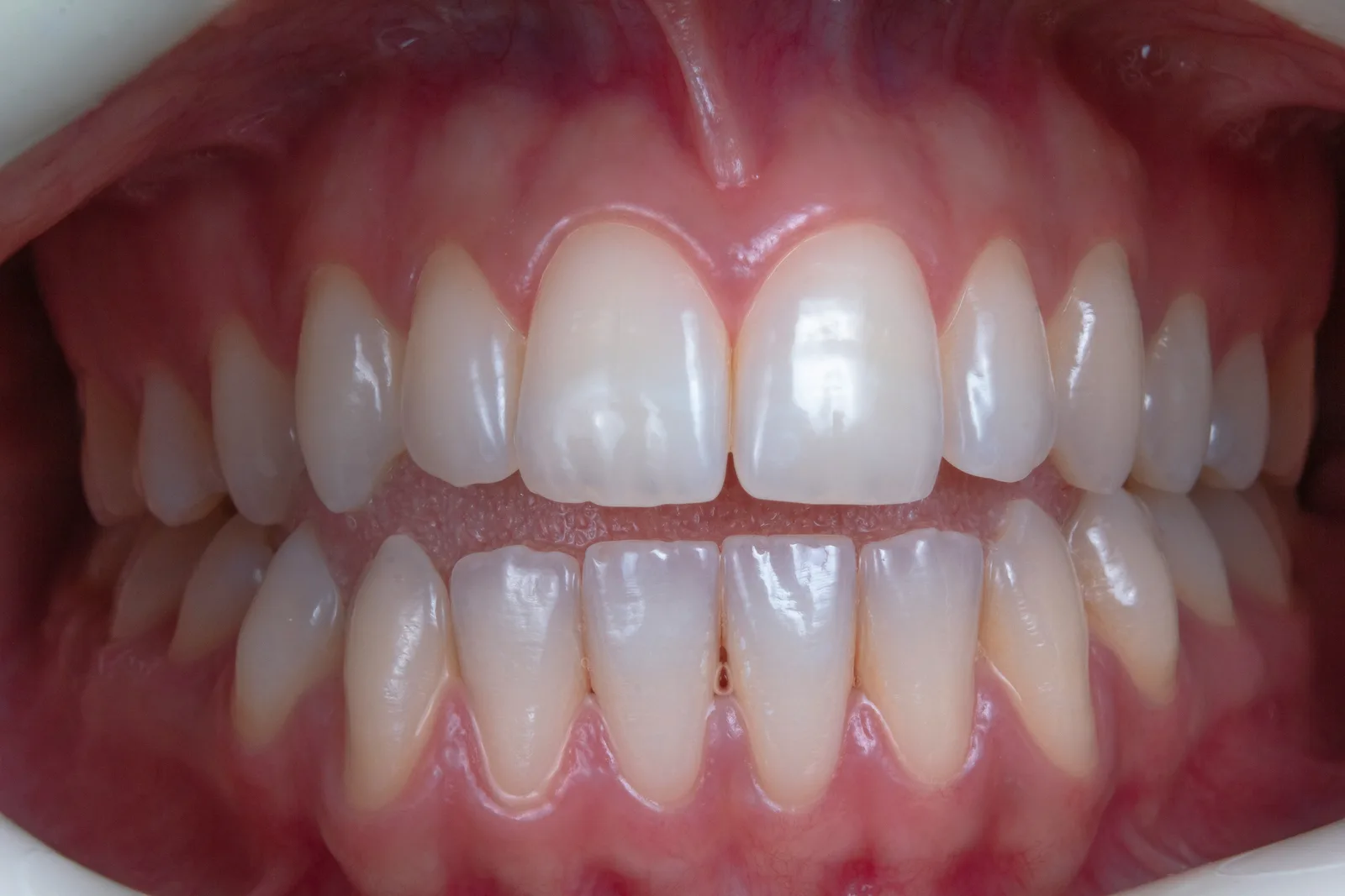 Full arch intraoral view of the teeth, shown while covering Implant Financing in Winnipeg