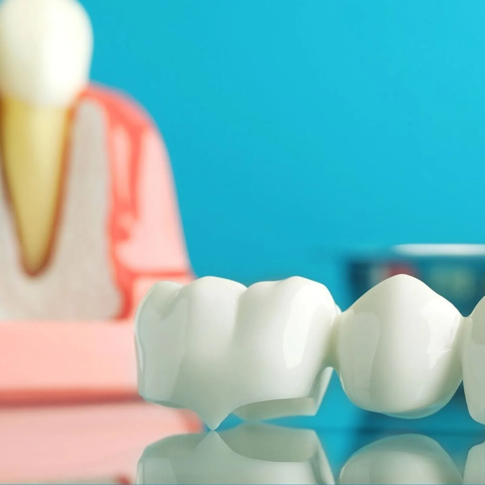 Implant and crown model on display, alongside the CBCT Imaging explanation in Winnipeg