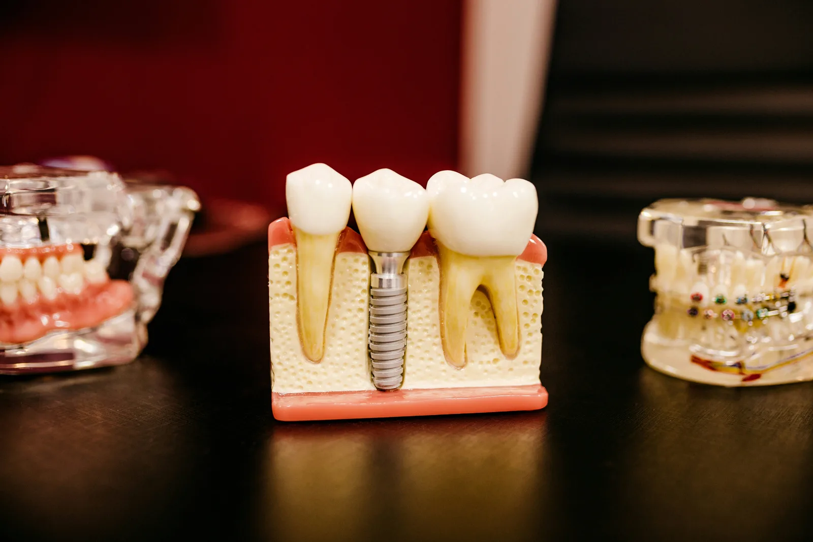 Cross-section model showing an implant in the jawbone, shown while covering dental implant treatment in Winnipeg