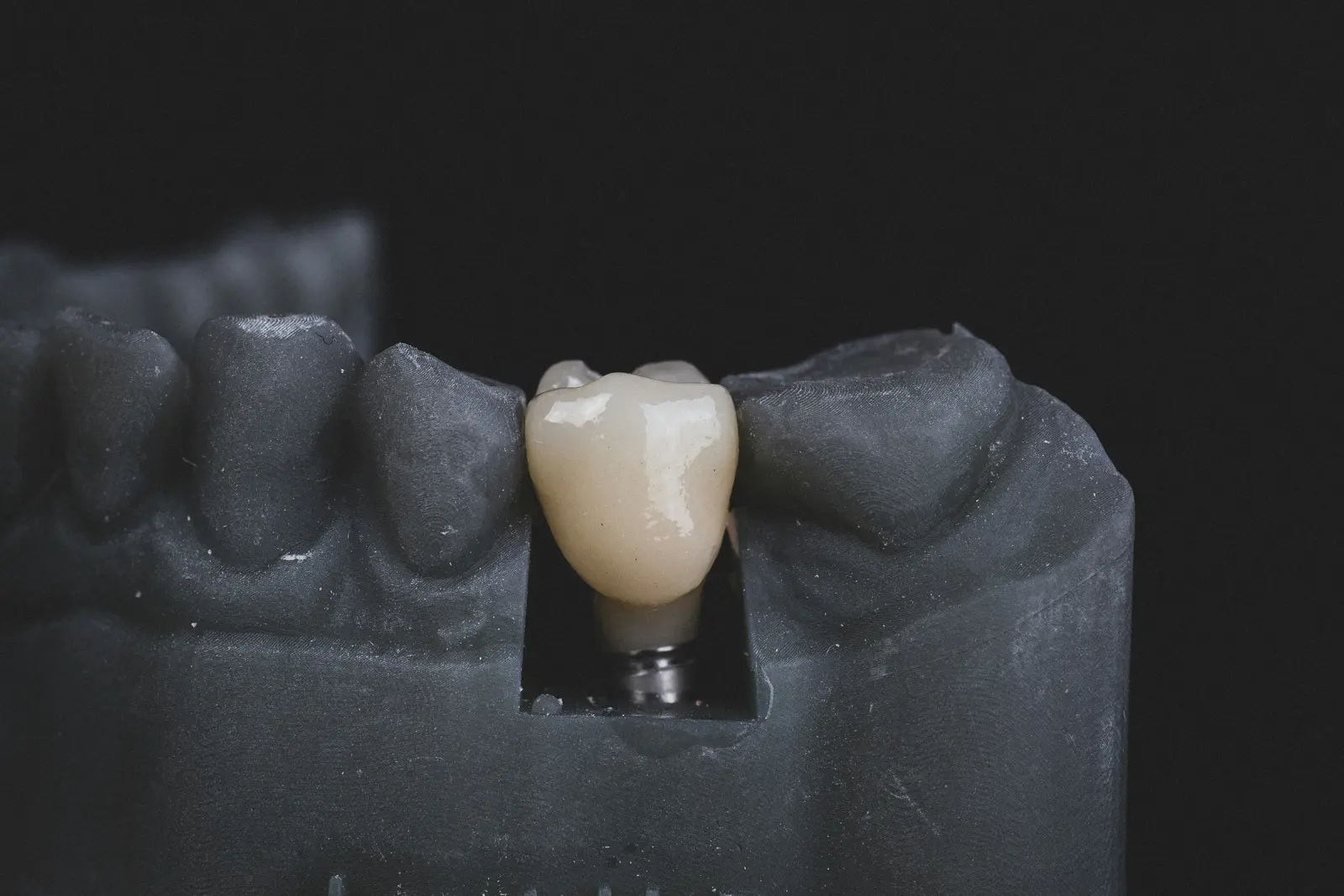 Implant crown seated on a working model, shown while covering Implant Services in Winnipeg