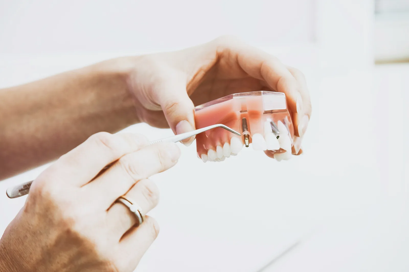 Implant model examined with a dental probe, shown while covering Guided Implant Surgery in Winnipeg
