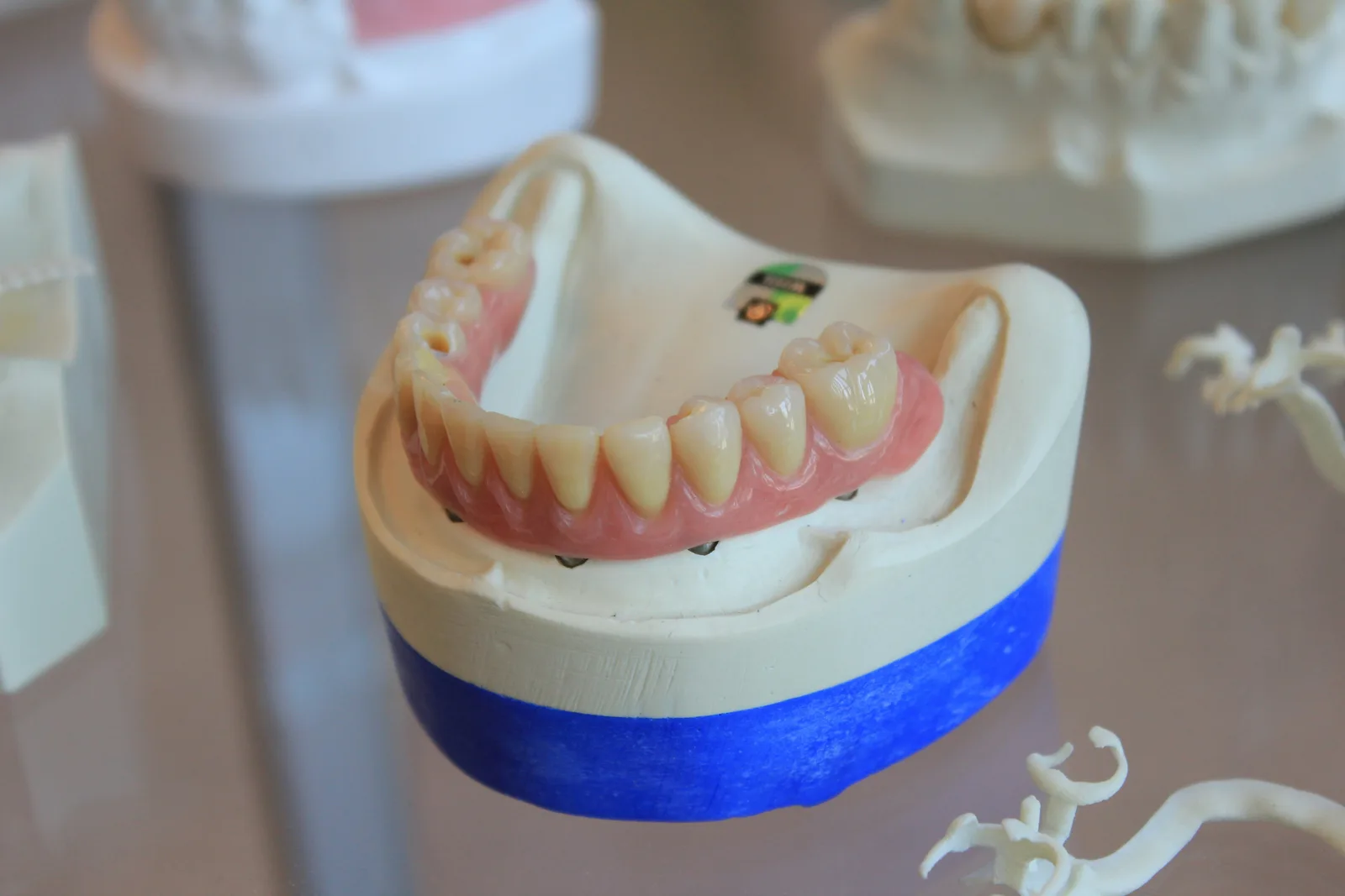 Implant supported denture on a study model, referred to in the Implant Crown section for Winnipeg