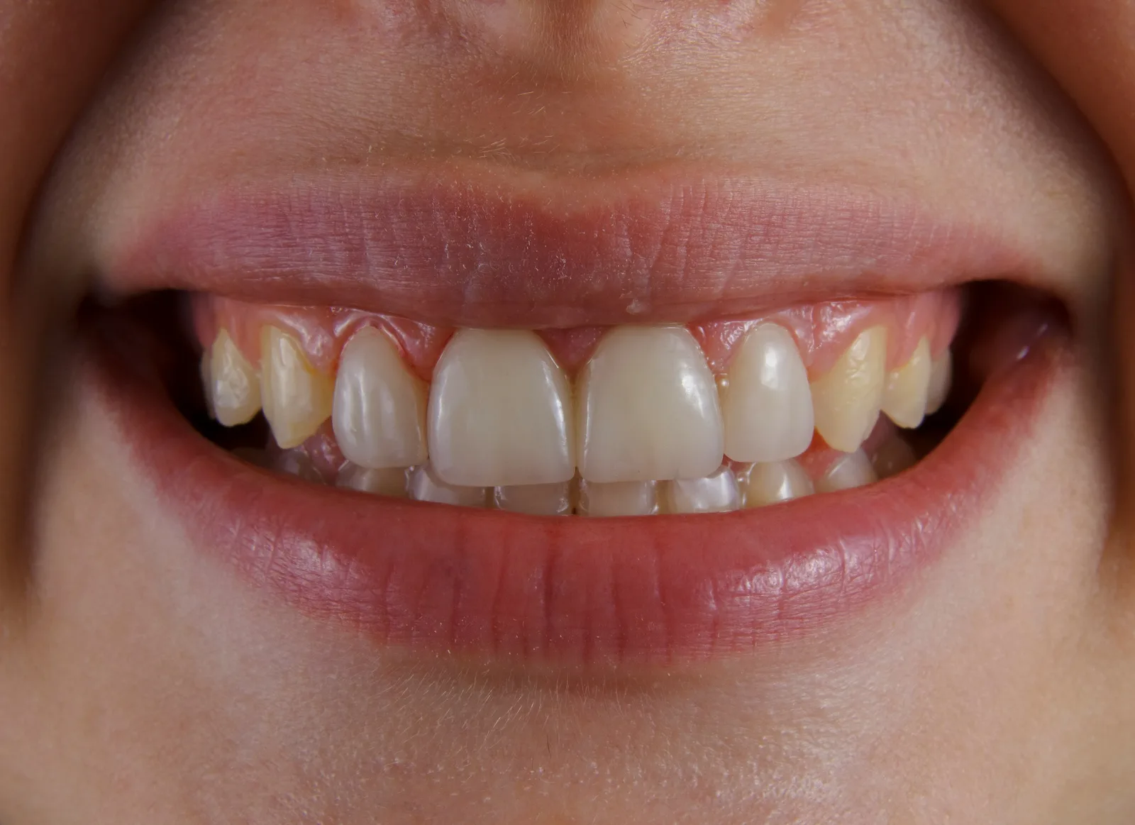 Close-up of a natural smile, referred to in the Guided Implant Surgery section for Winnipeg