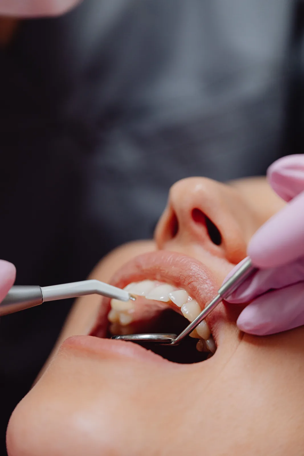 Polishing the teeth after treatment, referred to in the All-on-4 Implants section for Winnipeg