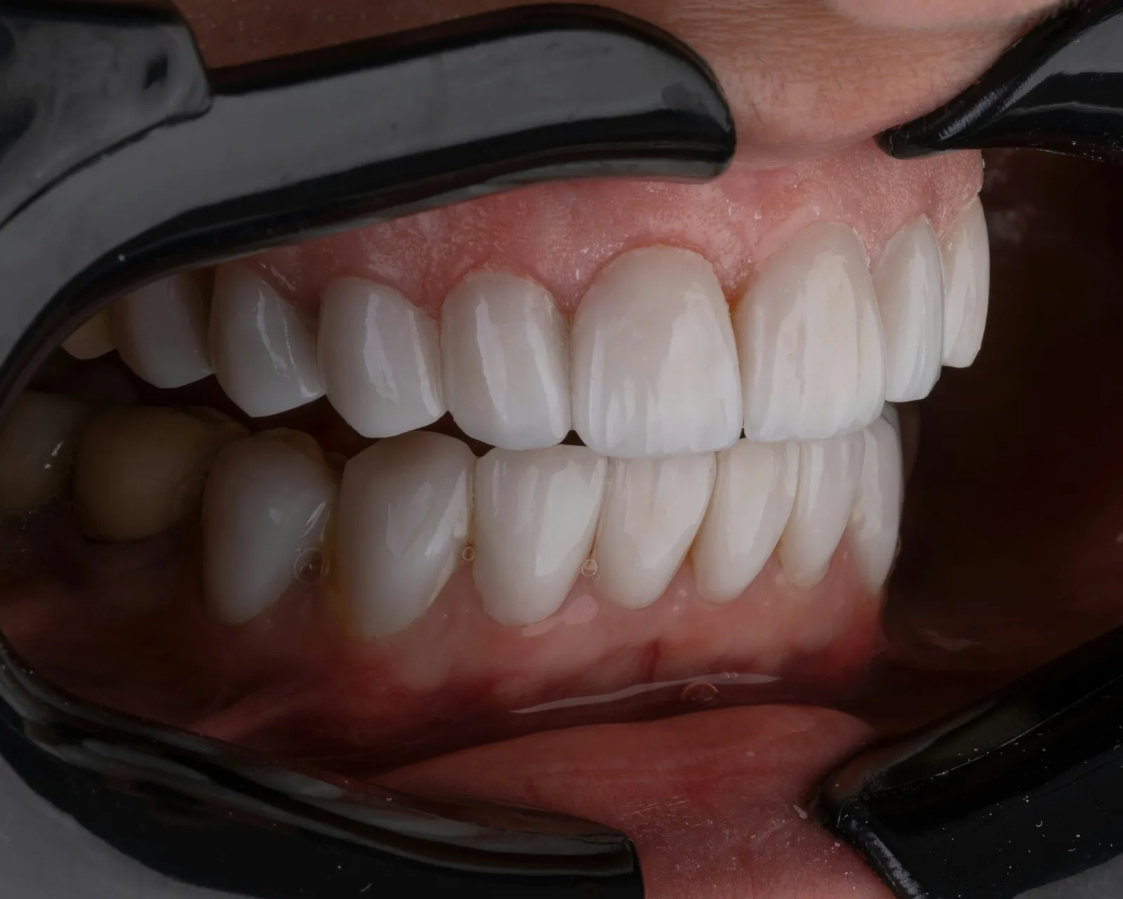 Intraoral view of several restored teeth in one arch, after multiple tooth implants in Winnipeg