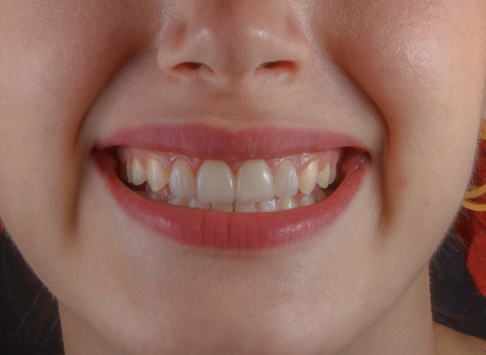 Close-up of a smile before treatment, shown while covering Implant Consultation in Winnipeg
