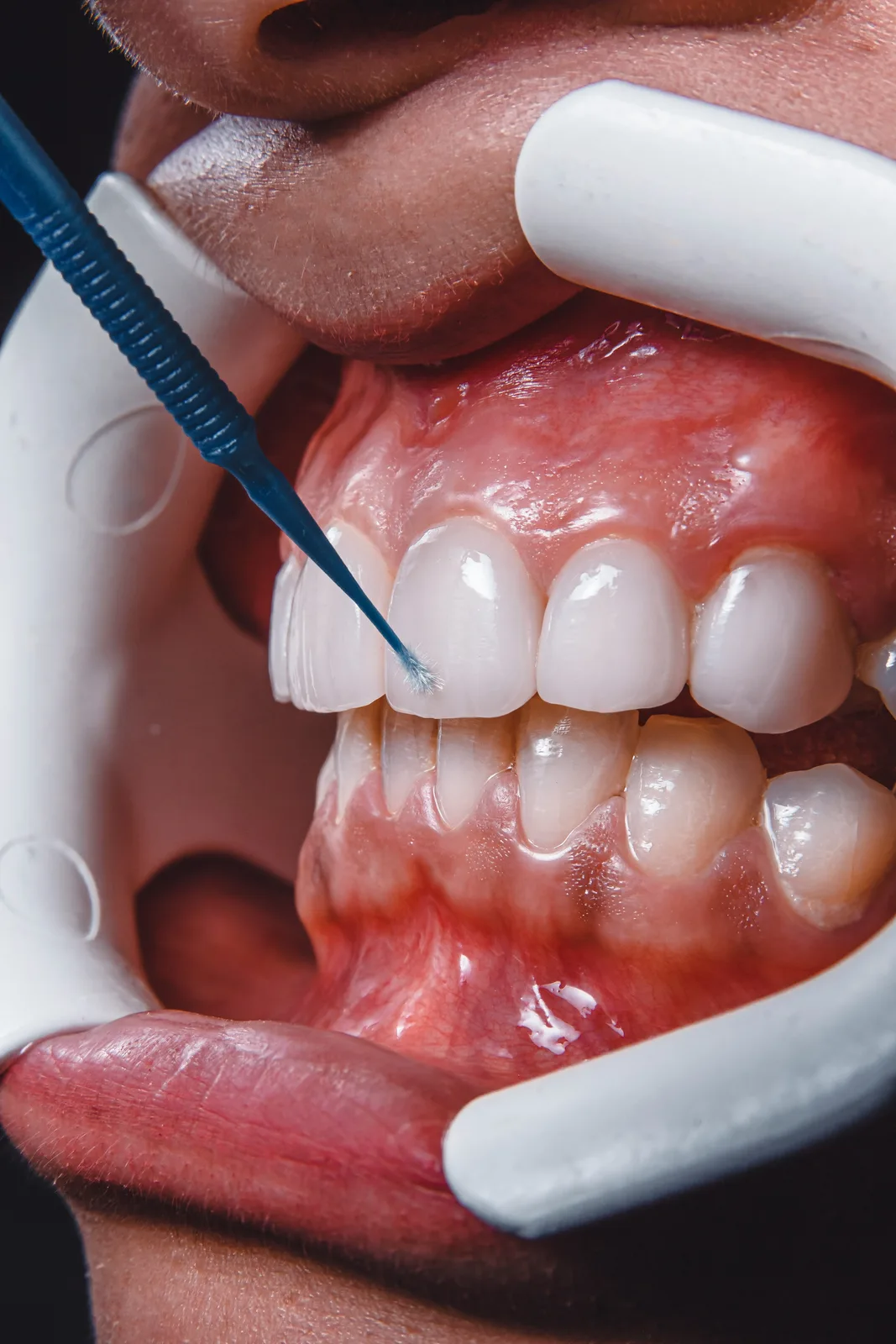 Tooth preparation with cheek retractors in place, alongside the Guided Implant Surgery explanation in Winnipeg