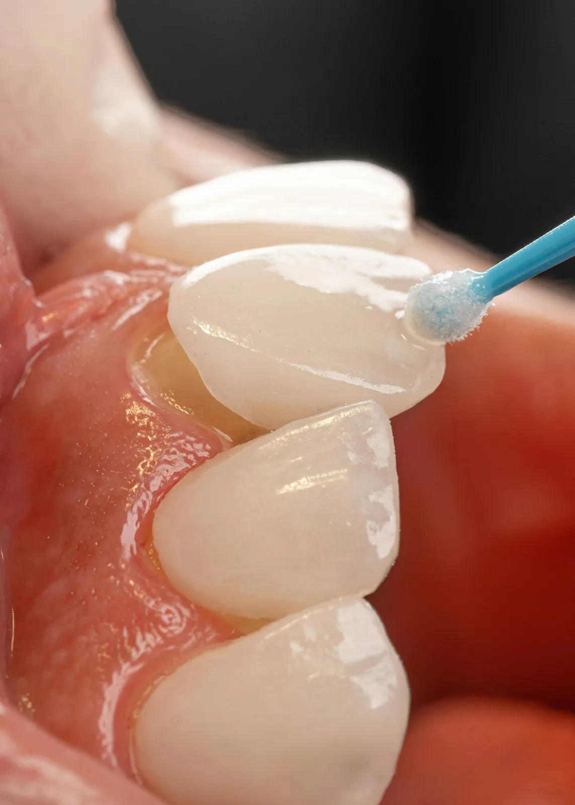 Close-up of tooth surface preparation, referred to in the What Are Dental Implants section for Winnipeg